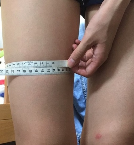 太ももの経過写真２