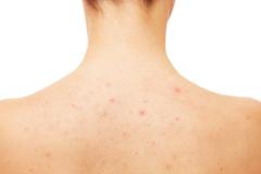 夏までにどうにかしたい！背中・胸元の肌荒れの原因と対策 | ビューティーガールからの美