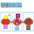 筋トレ民にとって筋肉痛っていいこと？“筋肉に効いてる証拠”という噂を整形外科医が解